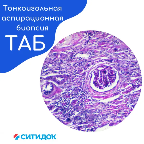 Тонкоигольная аспирационная биопсия (ТАБ)